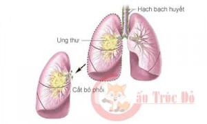 thuốc Fucoidan chữa ung thư phổi