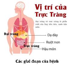 trien vong trong dieu tri ung thu dai truc trang