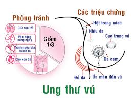 trieu chung va bieu hien ung thu vu