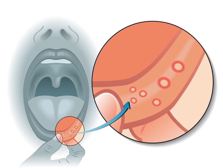 Bạn có biết rằng loét miệng có thể gây ung thư lưỡi?