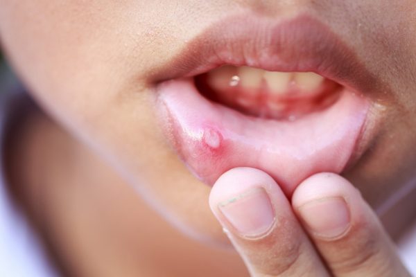 Các triệu chứng ban đầu của ung thư miệng