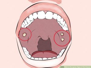 Người thích ăn trầu cần đề phòng 4 triệu chứng ung thư ở miệng.